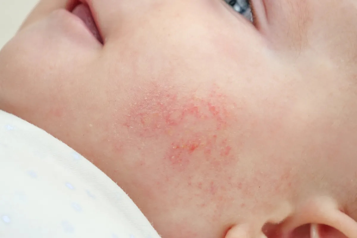 My baby has red spots on their face: what should I do?