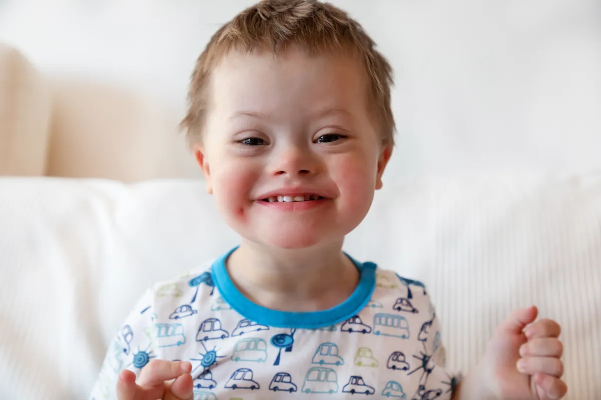 Down Syndrome: Causes And Physical Features