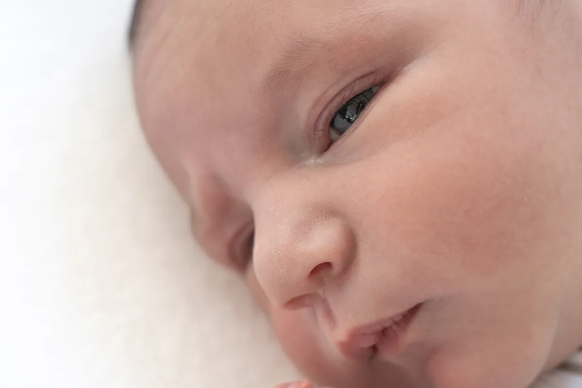 Is Lanugo Normal in Newborns?